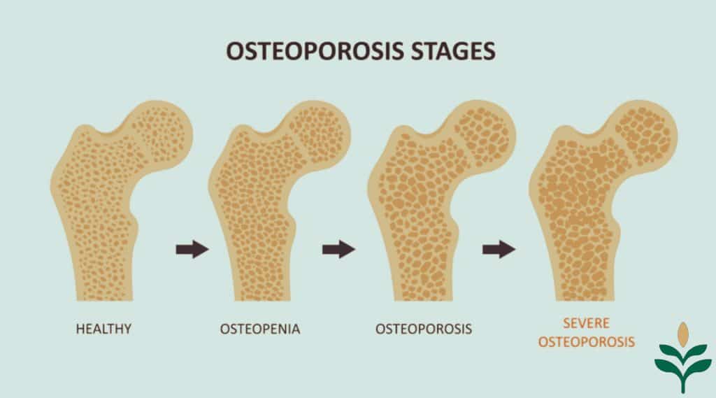 The evolution of Osteoporosis is classified into four different phases