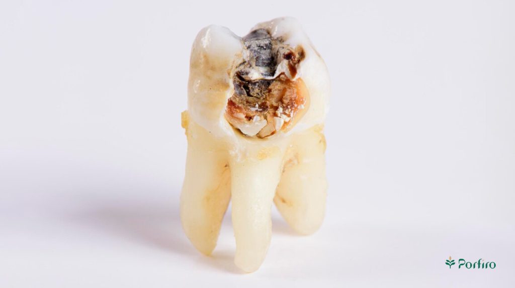 Decayed tooth