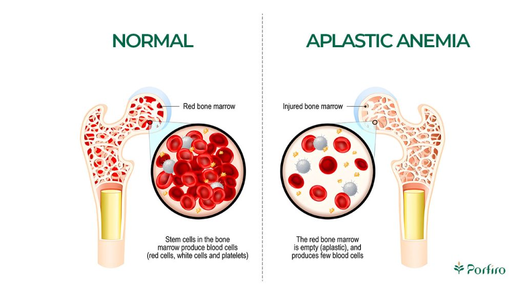 symptoms of anemia