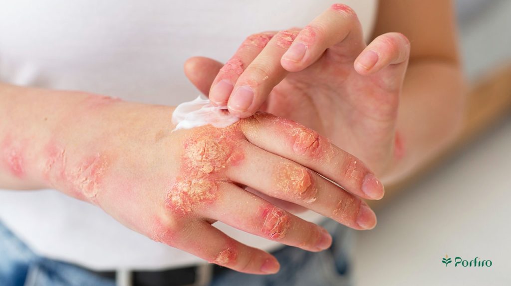 The hands of a person who has skin inflammation due to allergies and is applying cream to them