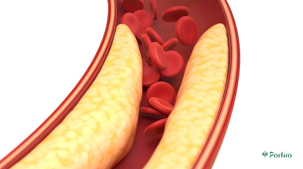 A blood vessel in which cholesterol has deposited, narrowing the passage of red blood cells.