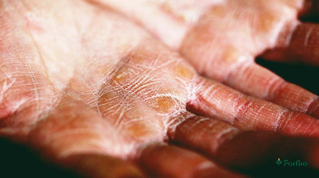 Completely dry palms, which indicates dehydration.