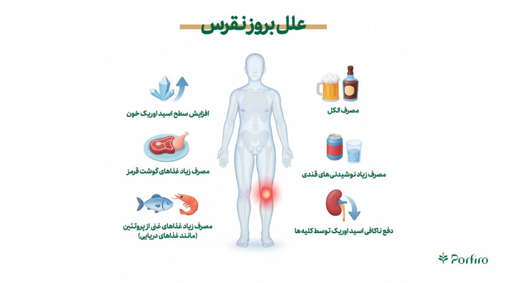 اینفوگرافیک علل بروز نقرس